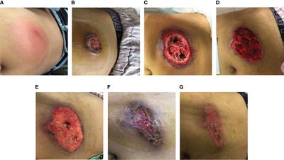 Atypical Sweet syndrome: skin sinus tracts in an acutely febrile patient after lymphoma treatment: a case report